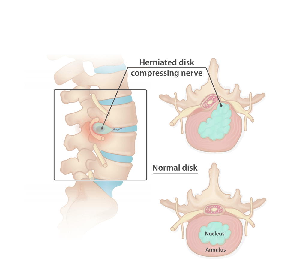 Medical illustration of a herniated spinal disc pressing near a nerve root
