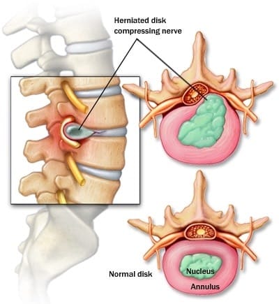 Comparison of a normal spinal disc and a herniated disc pressing near a nerve